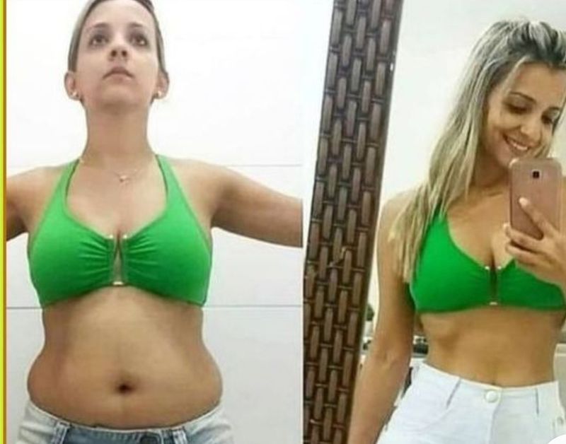 Tummy reductions