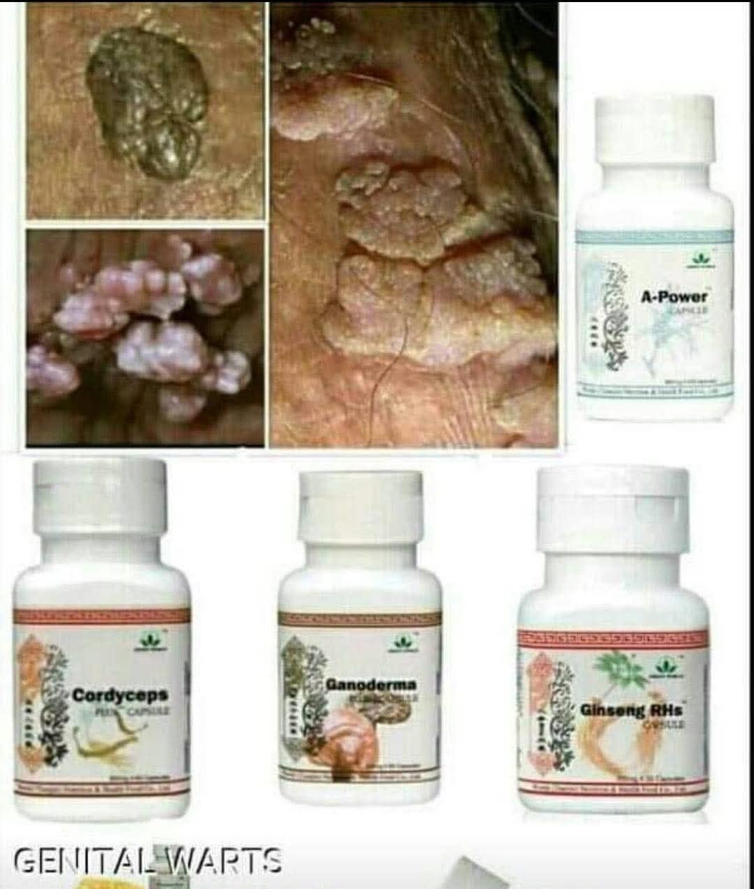 Genital warts treatment package