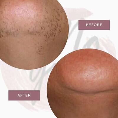 No Grow Male Beard remover
