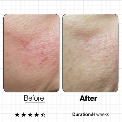 SENSITIVE SKIN
