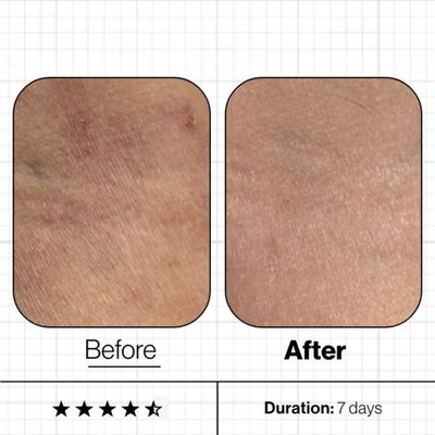 DRY SKIN