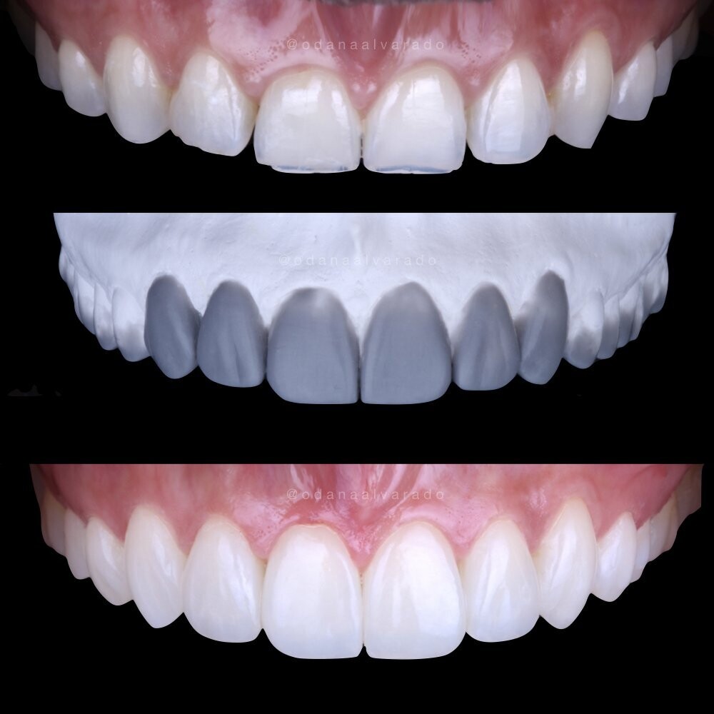 DIY Course - Diagnostic Wax Up applied to the clinical planning phase on a real patient