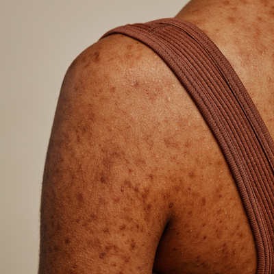 Acne &amp; Pigmentation