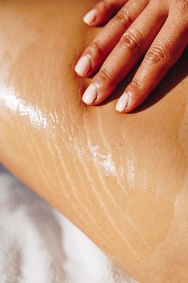 Stretchmark &amp; Cellulite