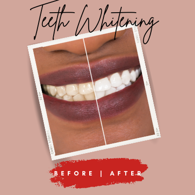 Teeth Whitening