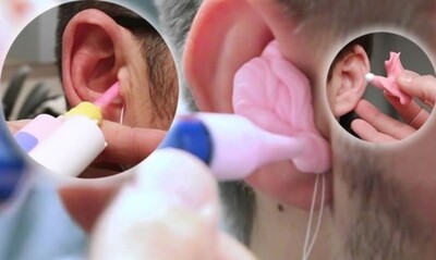 Ear impression material being used in ear