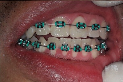 Ortodoncia (brackets)