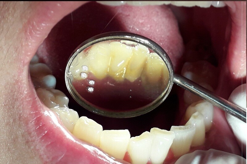 Limpieza dental con ultrasonido