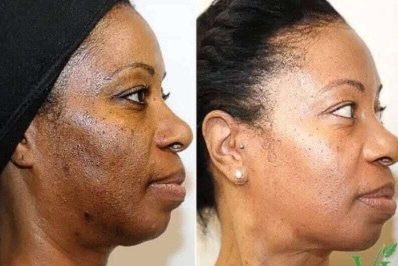 Soap - Skin Lightening