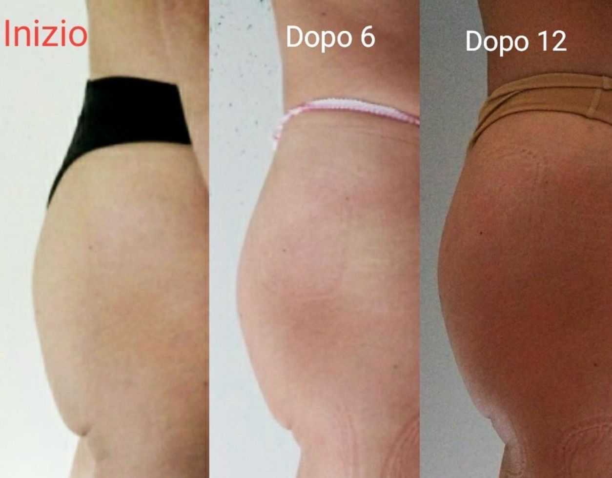 Rimodellamento Glutei 10 sedute