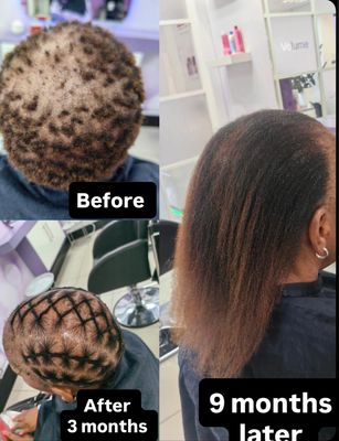 Alopecia Regrowth