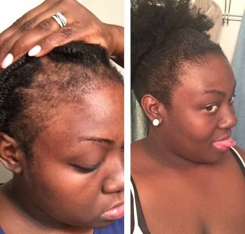 Hairline Regrowth