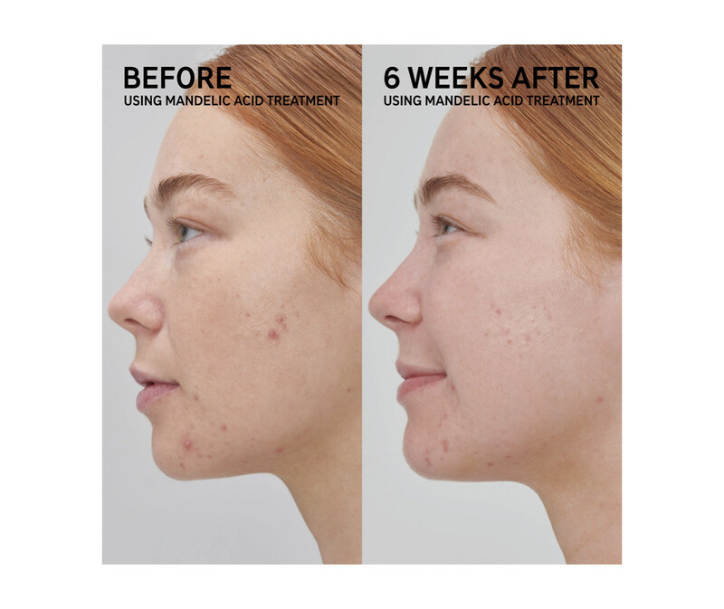 The Inkey List - Mandelic Acid Treatment 