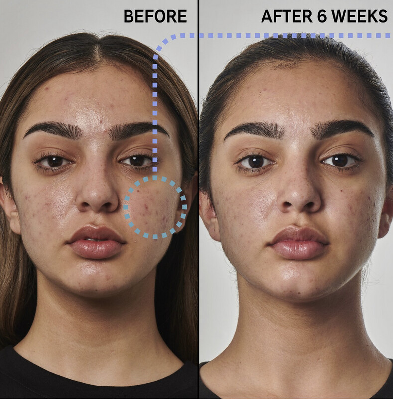 The Inkey List - SuperSolutions 5% Benzoyl Peroxide Cleanser Acne Solution