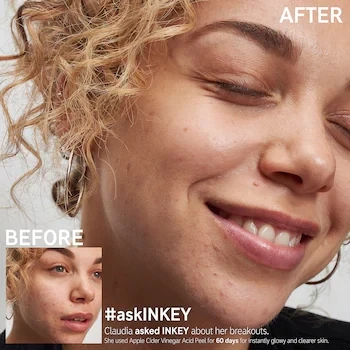 The Inkey List - Apple Cider Vinegar Acid Peel