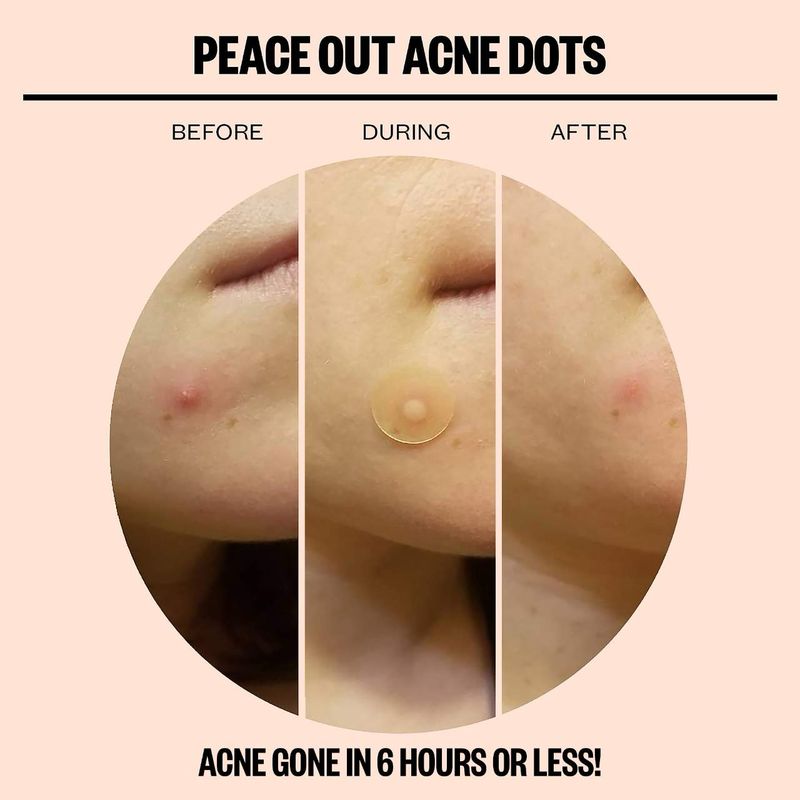 Peace Out - Salicylic Acid Acne Healing Dots | 10 healing dots