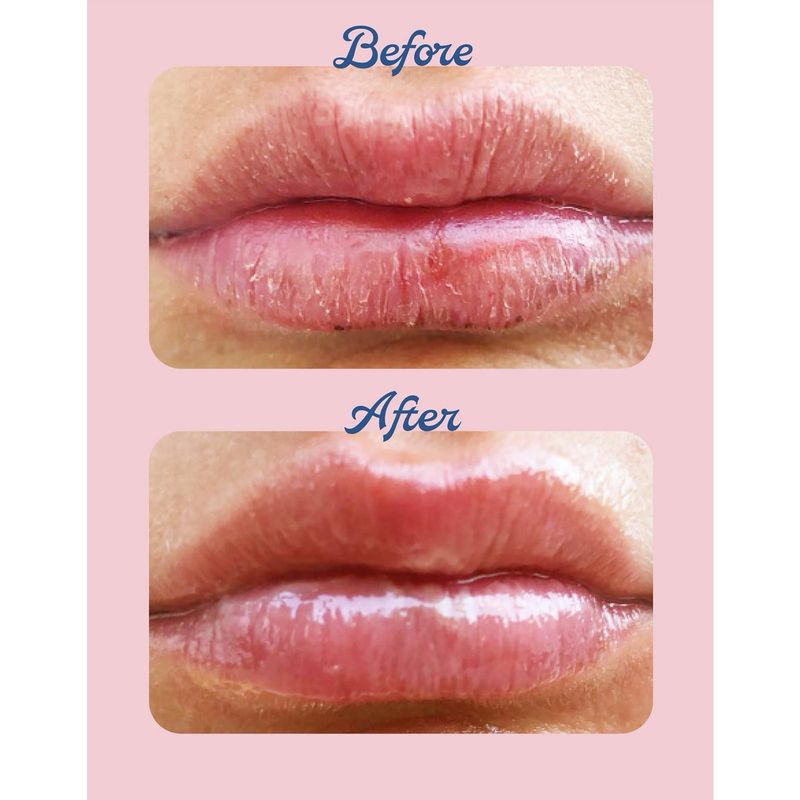 Lanolips - Strawberry 101 Ointment Multi-Balm - Dry Lips Treatment