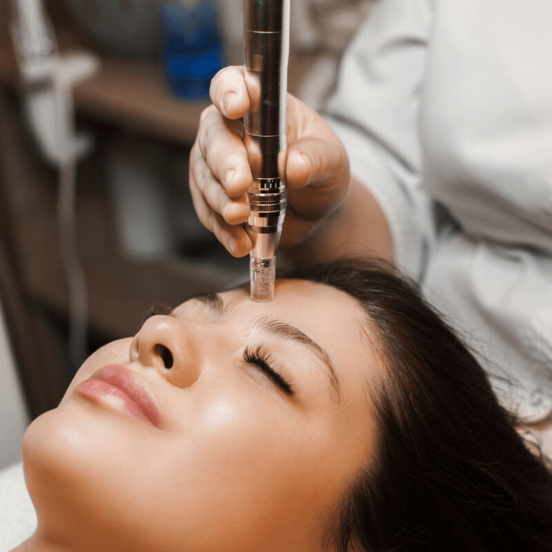 Microneedling