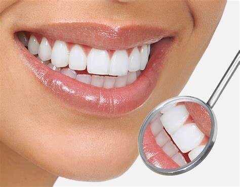 Lot de 5 ​seringues de 5 ml de gel blanchiment dentaire américain