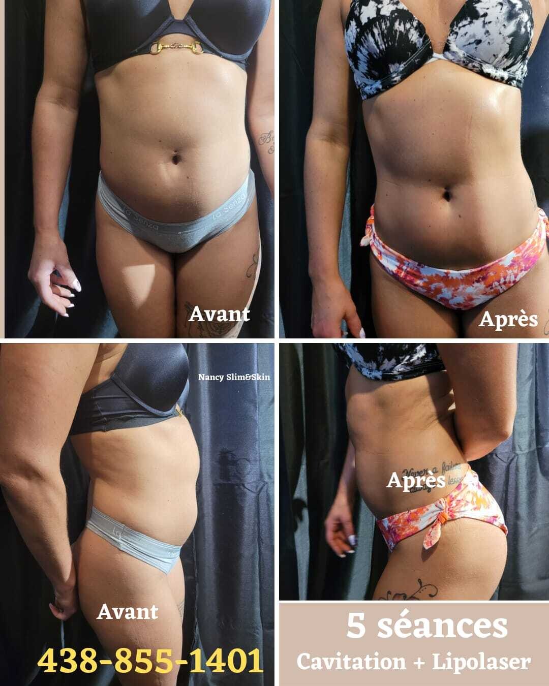 Avant - Après Cavitation Lipolaser et Lifting Colombien