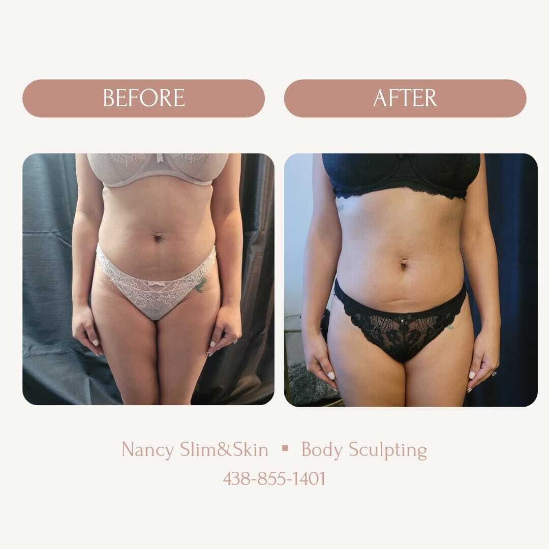 Avant - Après Lipocavitation