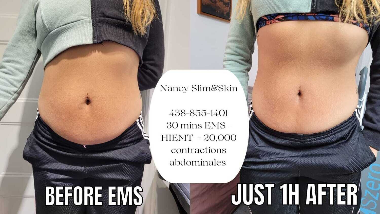 Avant - Après EMS