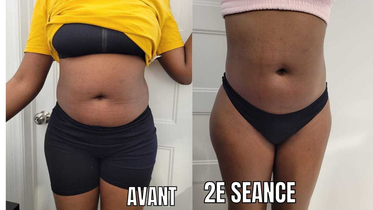 Avant - Après EMS et Pressothérapie