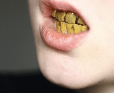 Lacas dentales