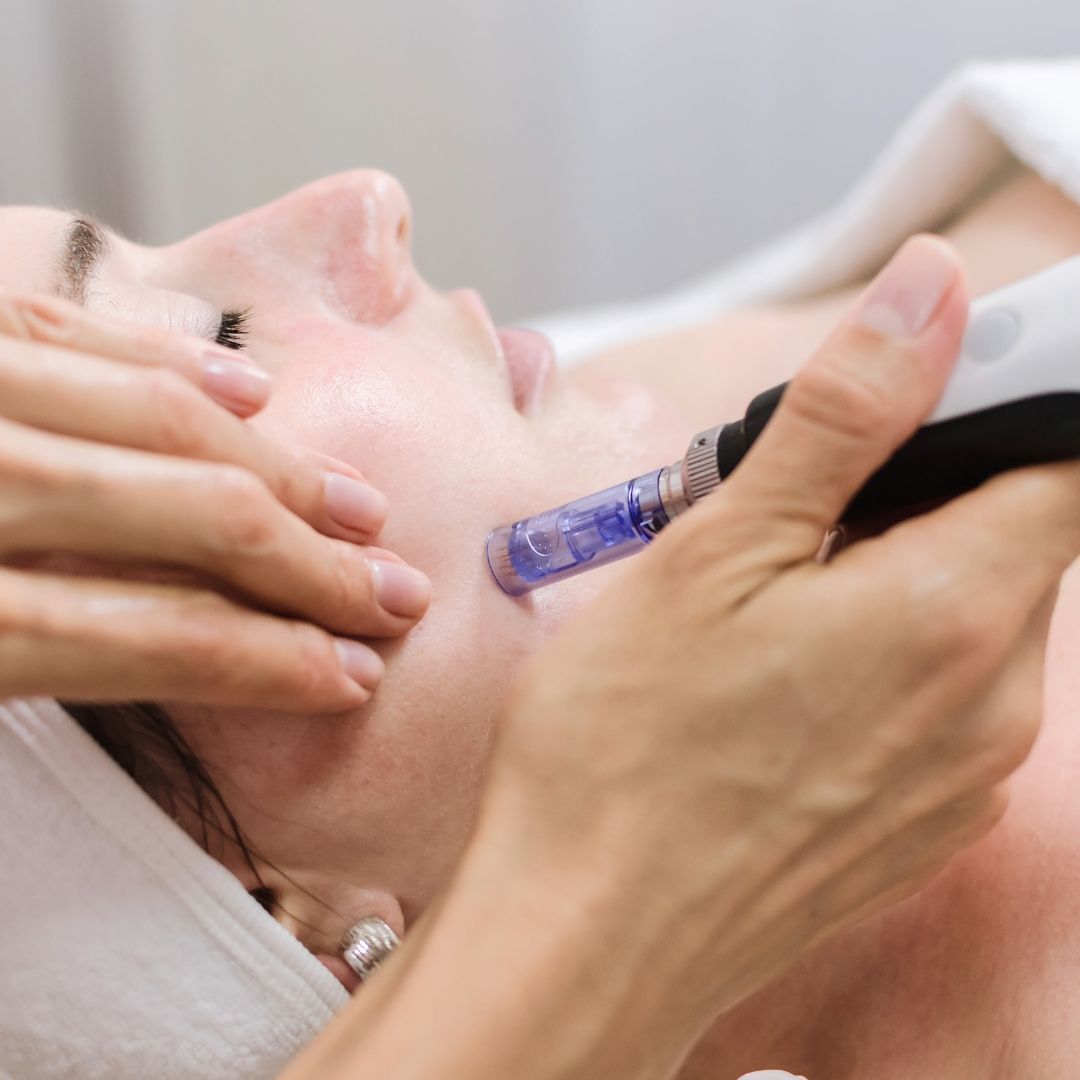 Dermapen si Oxigen Hiperbaric