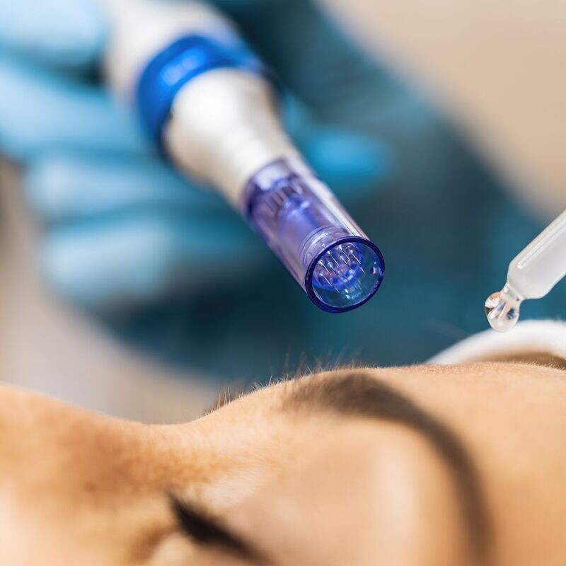 Microdermabraziune