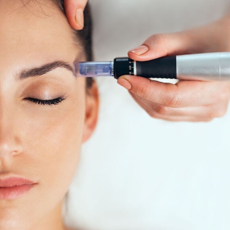 Dermapen si Oxigen Hiperbaric