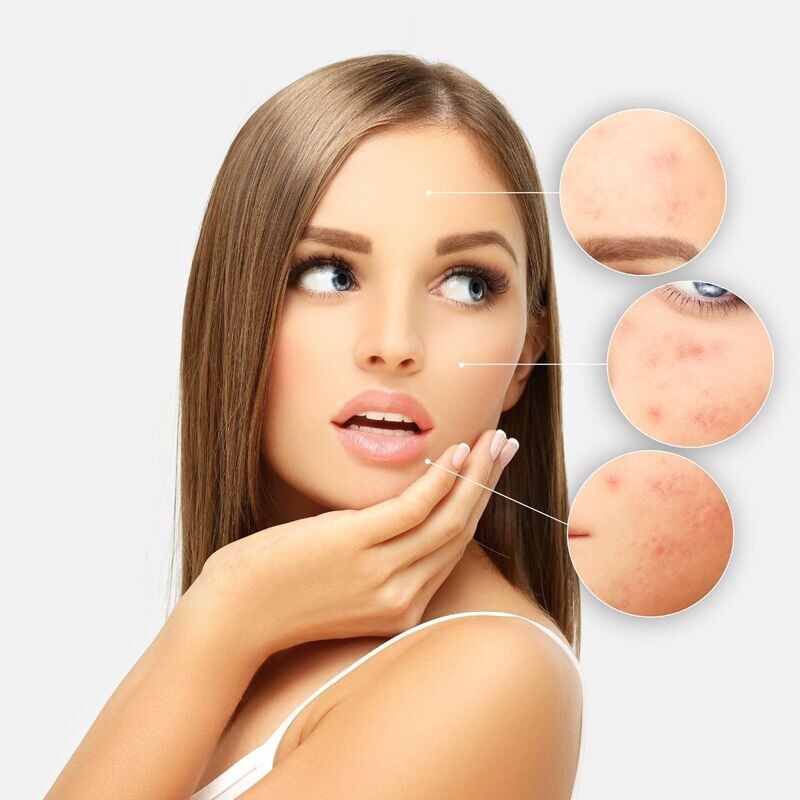 Acne Control Treatment