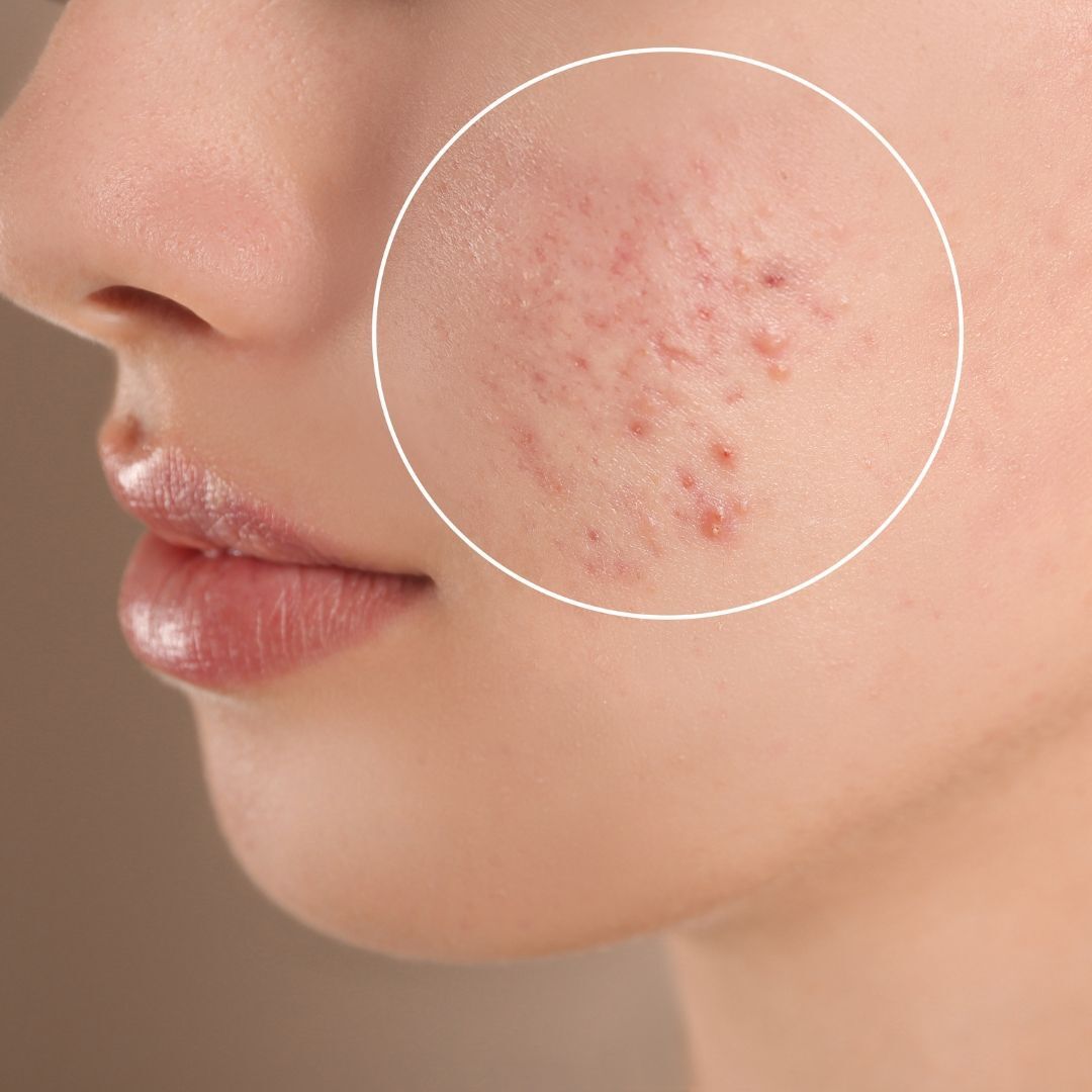 Acne Control Treatment