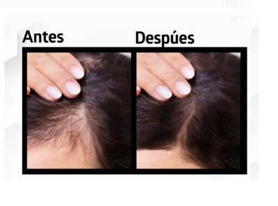 HAIR LOSS