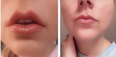 Lip Filler