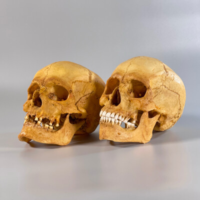 Мужской череп человека с метопизмом + женский череп человека с метопизмом (анатомические модели)