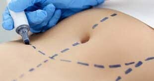Drainage lymphatique post opératoire