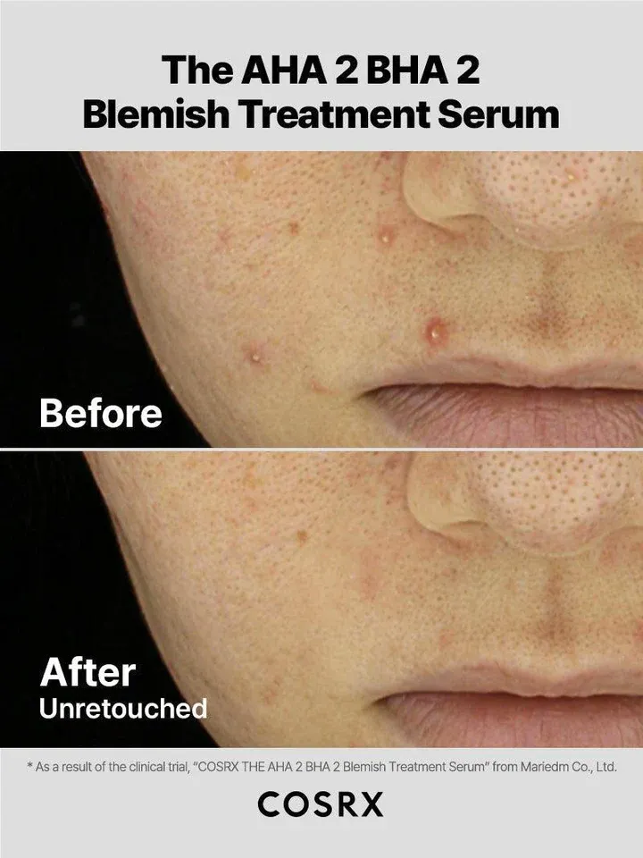 COSRX The AHA 2 BHA 2 Blemish Treatment Serum 50g