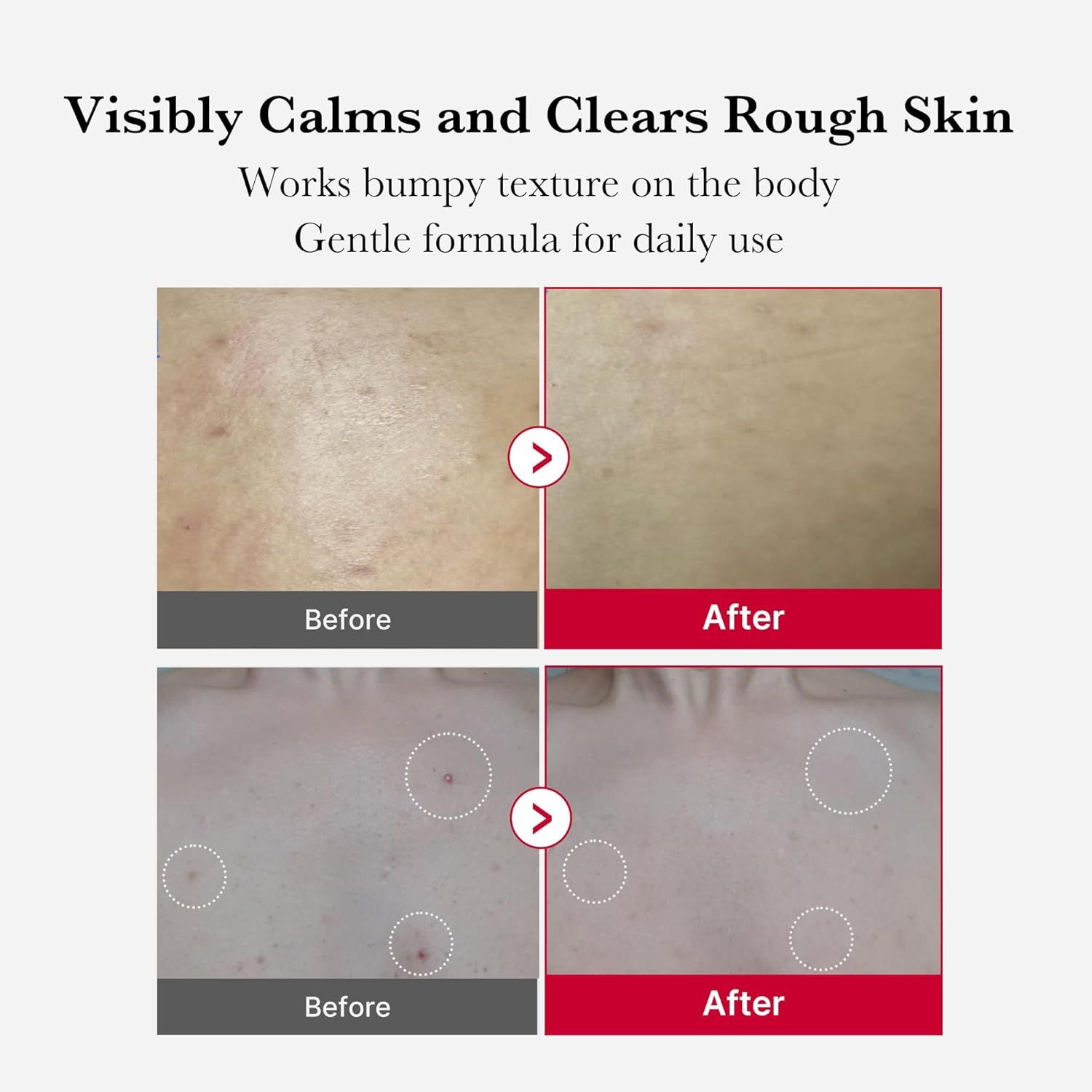 MEDICUBE Red Acne Body Peeling Shot 110g