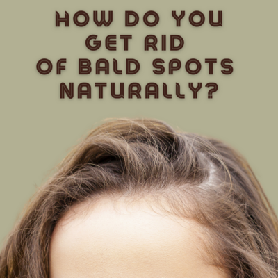 How do you get rid of bald spots naturally?