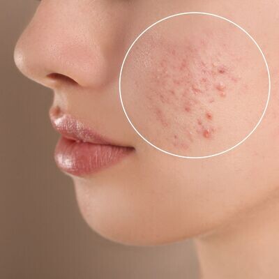 Purification Acne Treatment