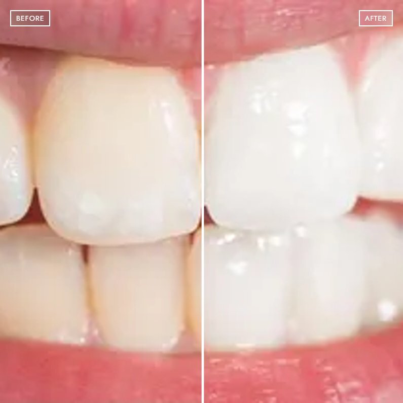 Diamond Teeth Whitening Strips & Colour Corrector in Ireland