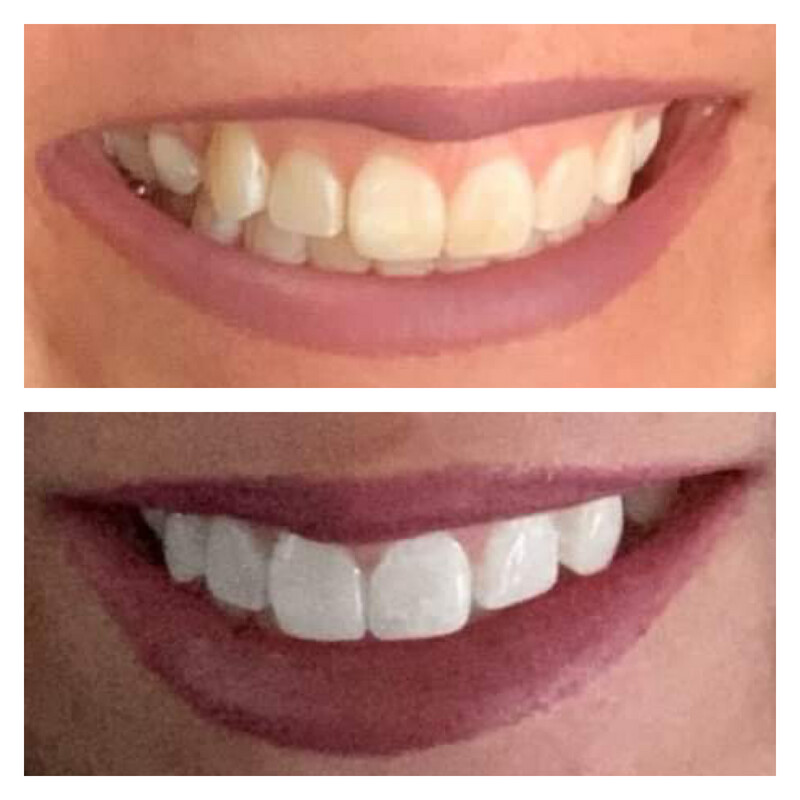 Whitening Toothpaste