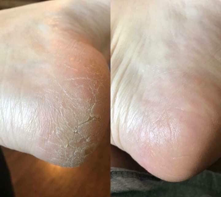 Pedicure in a Bottle