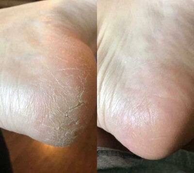 Pedicure in a Bottle