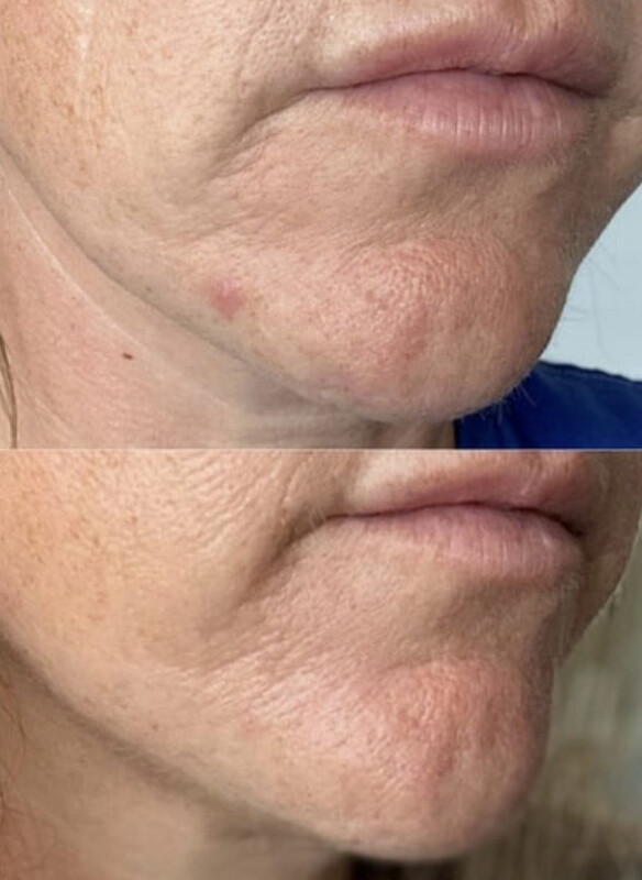 Blemish Serum