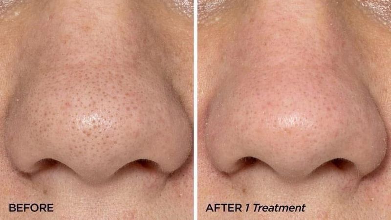 Microneedling Tool &amp; ageLOC® Tru Face® Line Corrector Bundle