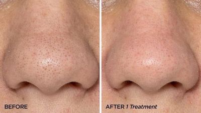 Microneedling Tool &amp; ageLOC® Tru Face® Line Corrector Bundle
