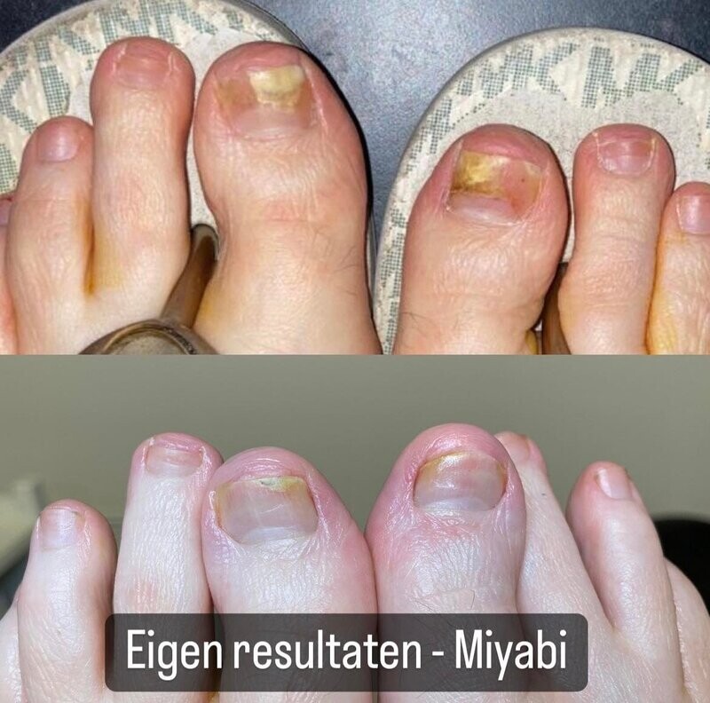 HET middel tegen schimmelnagels