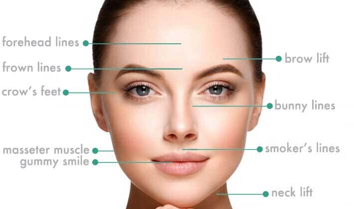Anti Wrinkle Injections 2 Areas